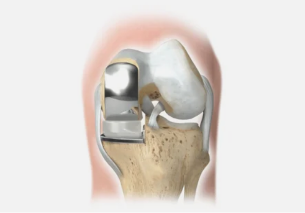 is damaged one part of the joint