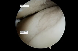 view astroscope on the knee joint with articular arthritis suffering from 3 degree