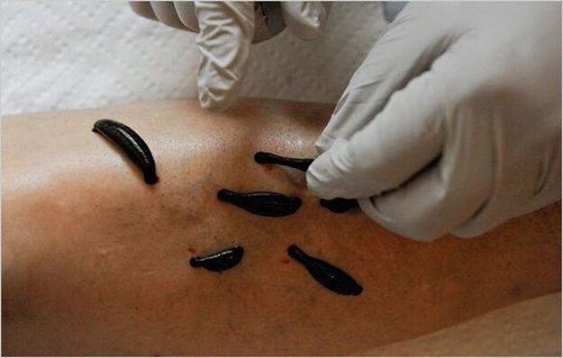 treatment of osteoarthritis of the knee with leeches