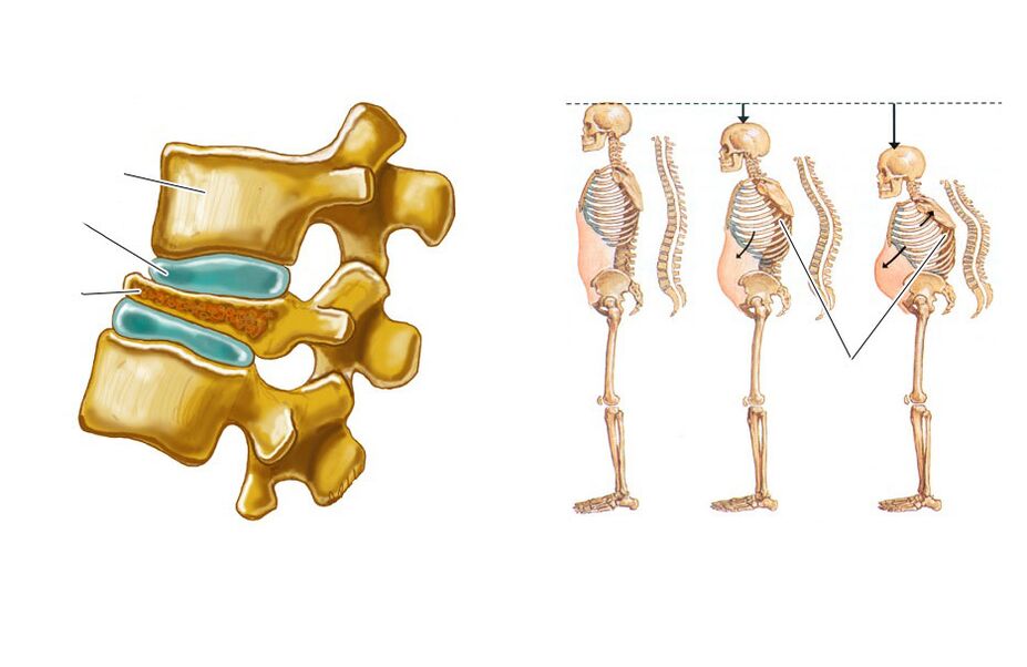 a sagging spine leads to back pain