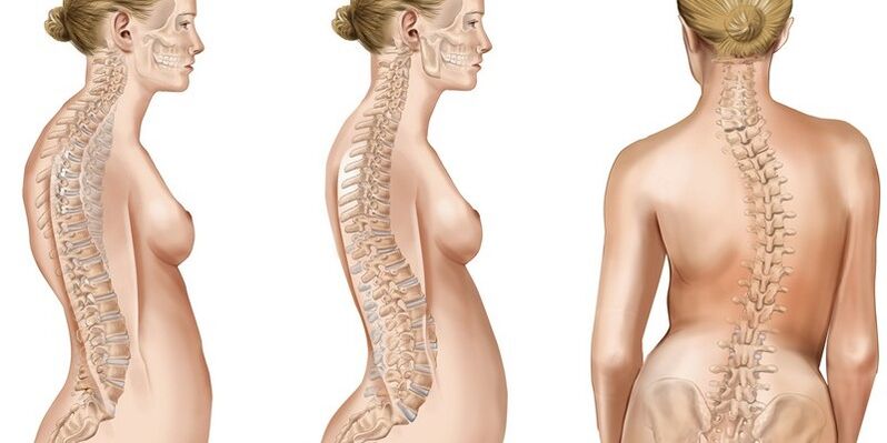 Scoliosis of the thoracic spine causes the appearance of pain in the shoulder blades