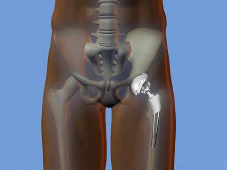 hip replacement for pain