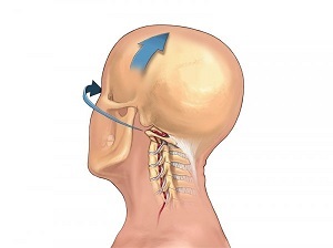 how is osteochondrosis of the cervical spine manifested