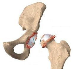 causes of osteoarthritis of the hip joint