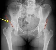 methods of treatment of osteoarthritis of the hip joint